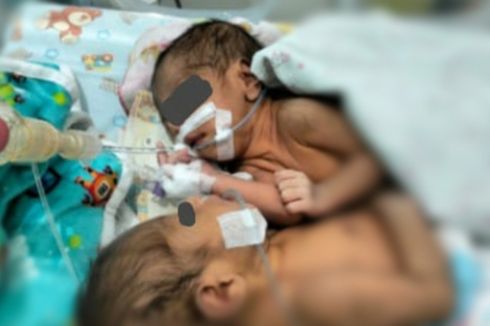 Bayi Kembar Siam Lahir di Flores Timur, Ayah: Kami Hanya Bisa Pasrah
