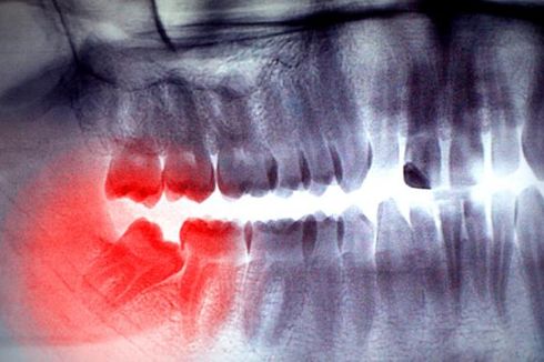 8 Penyebab Sakit Gigi Berkepanjangan dan Cara Mengatasinya