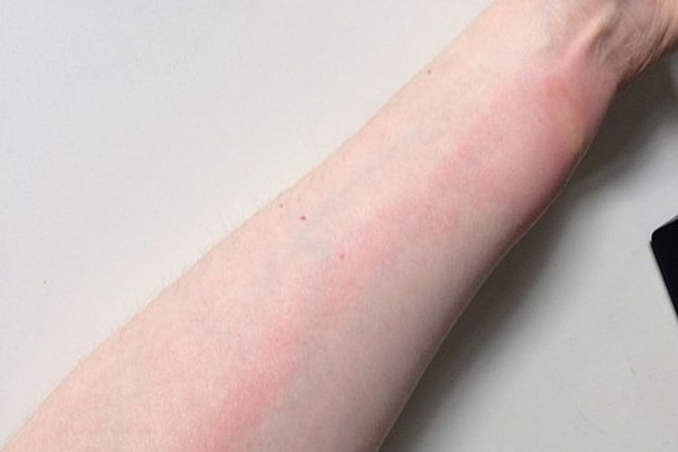 Garis merah di permukaan kulit bisa jadi tanda limfangitis