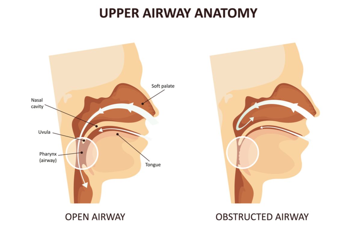 Ilustrasi Obstruksi Saluran Napas Atas