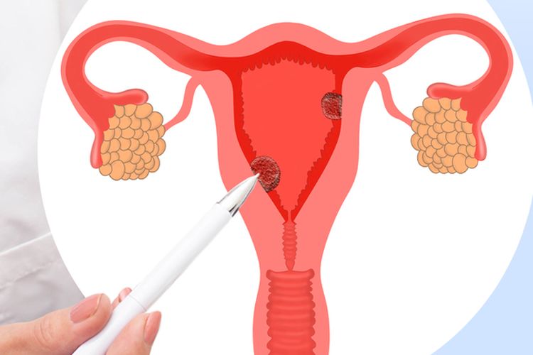 7 Cara Mencegah Kanker Rahim yang Penting Diketahui Para Wanita