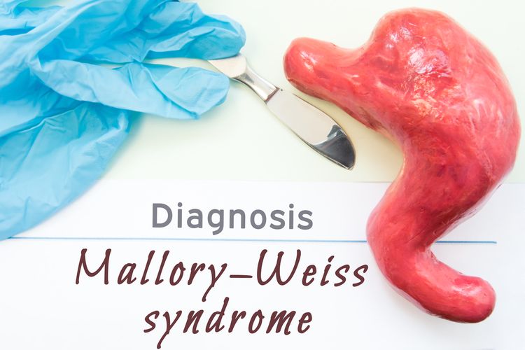Ilustrasi Mallory-weiss Syndrome