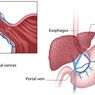 Varises Esofagus