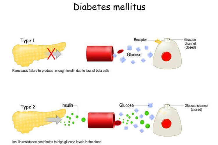 Pebedaan diabetes tipe 1 dan tipe 2.