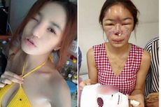 Ingin Hidung Mancung, Wajah Model Thailand Berakhir Rusak 