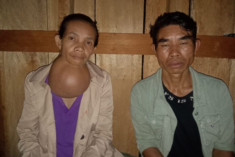 Sisilia Unut (kiri), wanita asal Manggarai, sudah menderita penyakit gondok selama 30 tahun. Kini, ukuran gondoknya sudah sebesar bola dan dia sangat menderita sehingga tak bisa bekerja lagi.