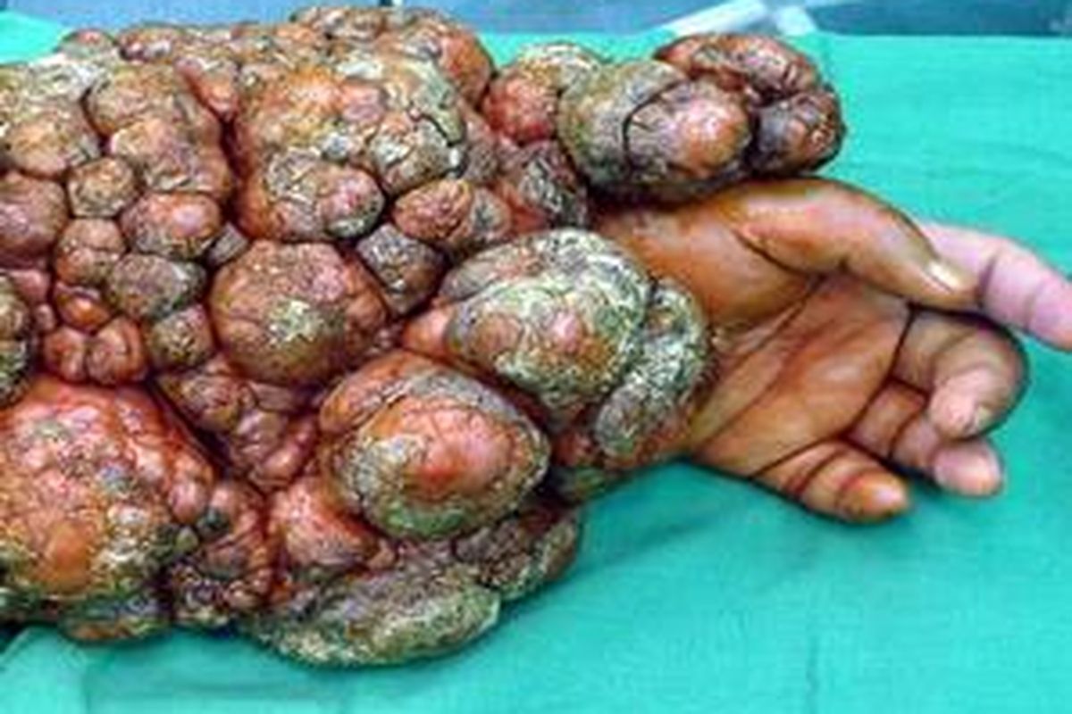 Tangan kiri Sutikno, pasien kanker kulit di RSU Dr Soetomo sebelum dioperasi. Pasien lain dengan penyakit yang sama, Sugeng Riyadi hingga kini belum dioperasi.