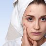 4 Perbedaan Rosacea dan Jerawat yang Perlu Diketahui