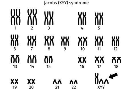 Sindrom Jacob (Sindrom XYY)