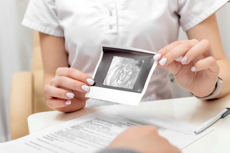 Ilustrasi kista ovarium. Apakah penderita kista ovarium bisa hamil? Simak penjelasan berikut...