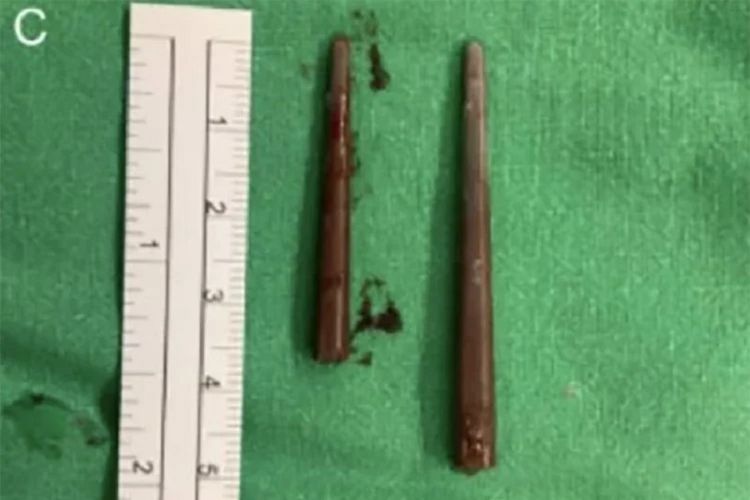 Dua pecahan sumpit yang diangkat dokter dari hidung seorang wanita di Taiwan.