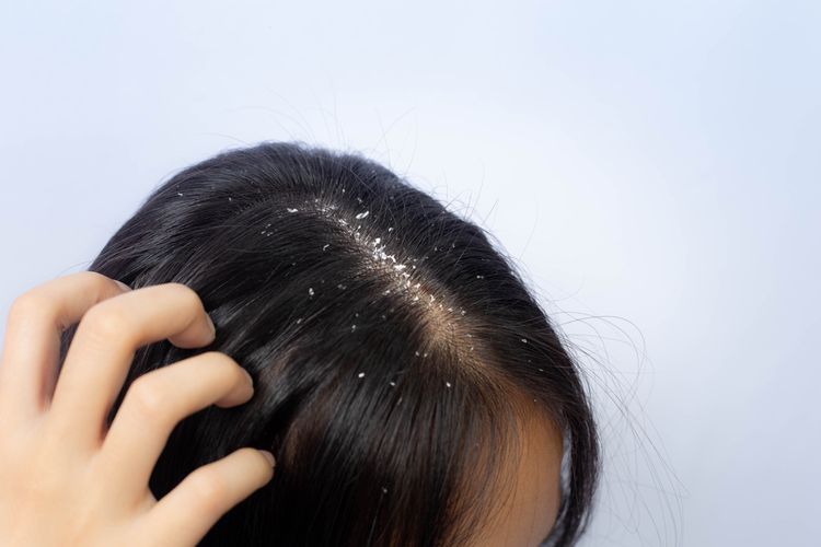 Kutu rambut menyebabkan gatal-gatal hingga kulit kepala mengelupas