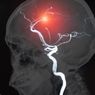 Aneurisma Otak: Gejala dan Penyebabnya