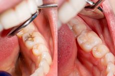 12 Penyebab Karies Gigi yang Perlu Diwaspadai