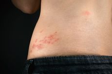 Bisakah Herpes Disembuhkan?