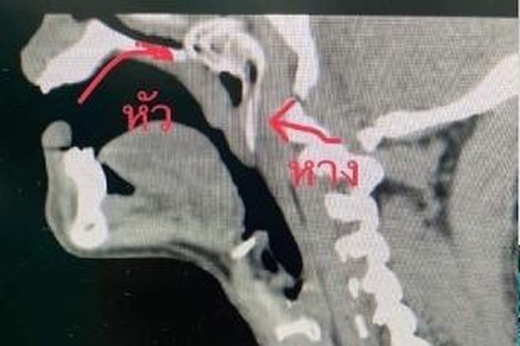 Hasil rontgen nelayan di Thailand yang mengalami kecelakaan langka, di mana ada ikan loncat masuk ke mulutnya. Kejadian itu dilaporkan terjadi pada Minggu (22/5/2022)