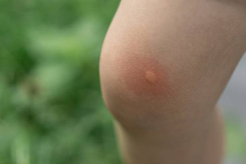 Mengapa Gigitan Nyamuk Menyebabkan Bengkak dan Gatal? Berikut Penjelasannya