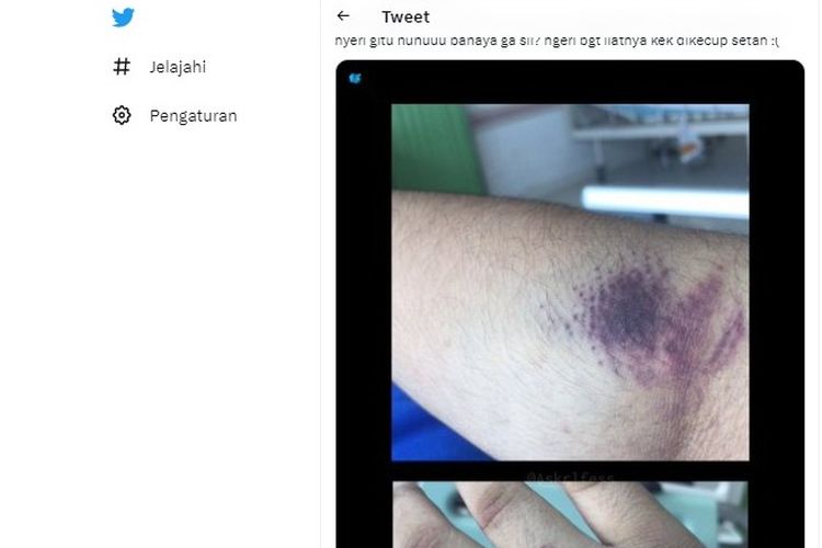 Ramai soal Memar akibat Bekas Suntikan, Apakah Berbahaya? Ini Penjelasan Dokter