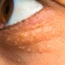 Kenali Apa Itu Xanthelasma, Tanda Kolesterol Tinggi di Tubuh