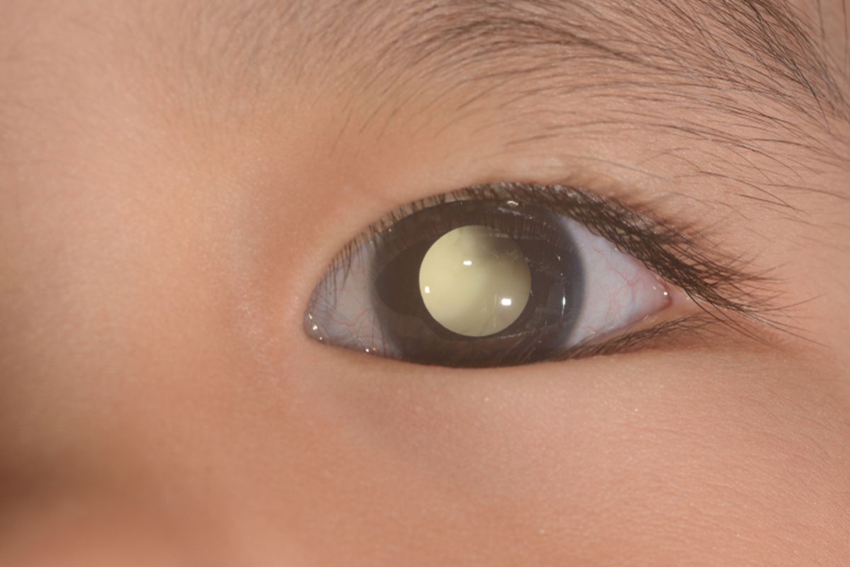 ilustrasi retinoblastoma