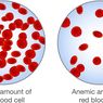 Anemia
