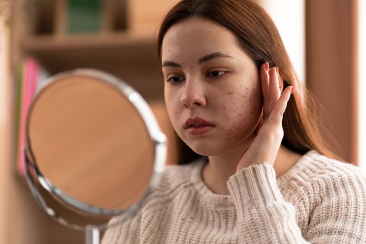 Kojic acid disebut bisa mengatasi flek hitam tanpa iritasi. Dokter menjelaskan cara kerja dan waktu yang dibutuhkan untuk melihat hasilnya.