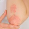 Penyebab Psoriasis yang Harus Diwaspadai