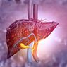 5 Bahaya Fatty Liver yang Perlu Diwaspadai