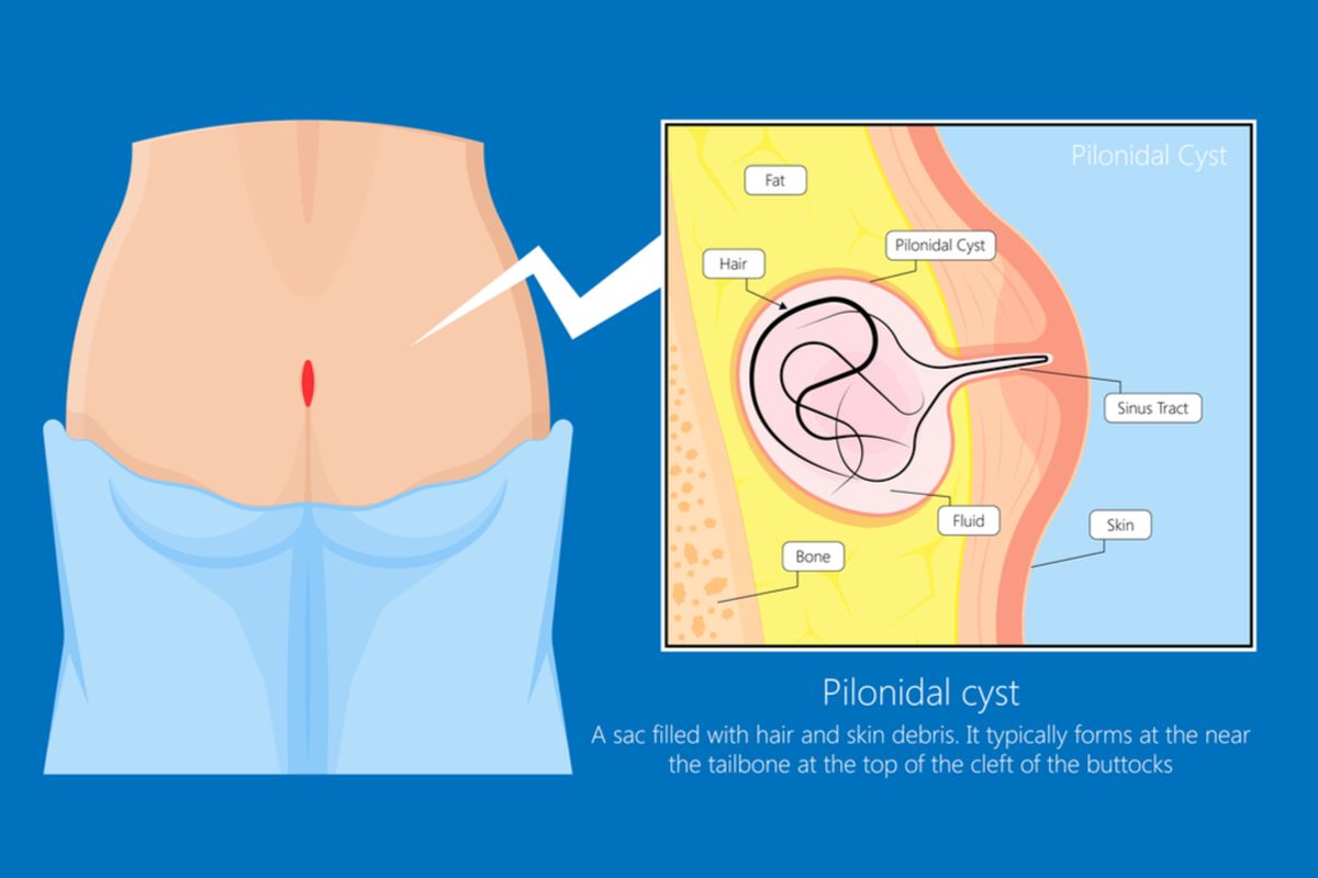 Ilustrasi kista pilonidal