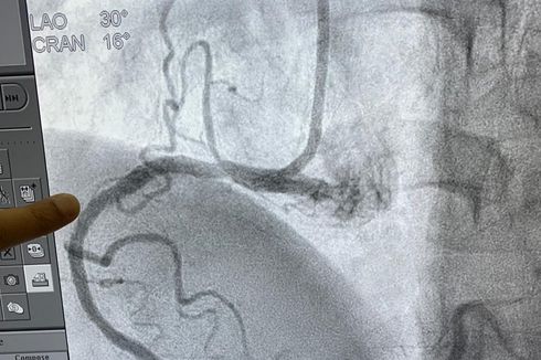 Apa Itu Pemasangan Ring Jantung untuk Pasien Penyakit Jantung Koroner?