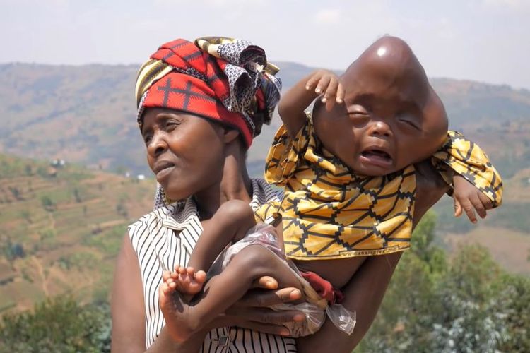Bajeneza Liberata bersama bayinya. Perempuan asal Rwanda itu meminta bantuan karena anaknya lahir dengan kondisi medis yang aneh.