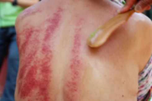 Mengenal Gua Sha, Kerokan ala China untuk Mengatasi Berbagai Penyakit