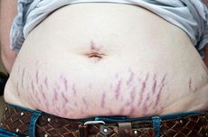 Stretch Marks