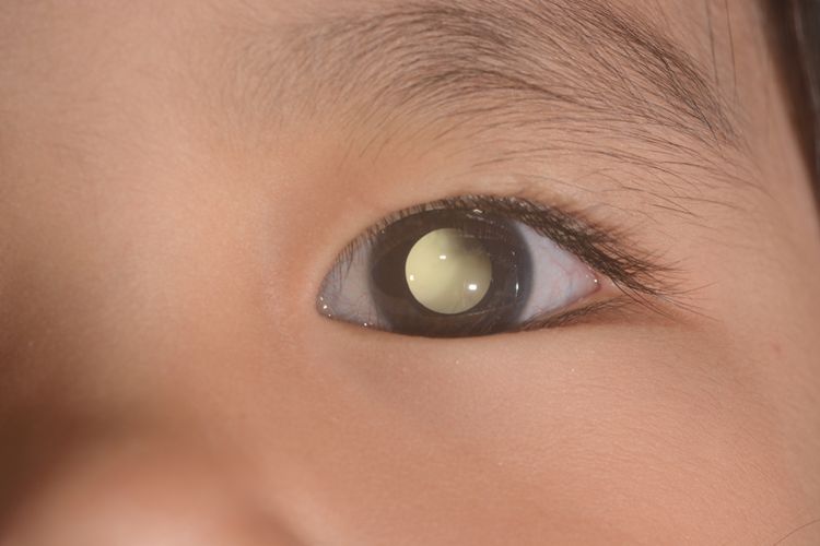 Ilustrasi retinoblastoma, kanker mata retinoblastoma, apa itu retinoblastoma. 