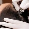 Microneedling dan Red Light Therapy dari ERHA untuk Atasi Kebotakan