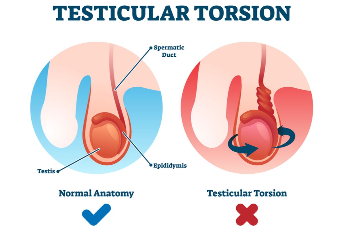 Ilustrasi Torsio Testis