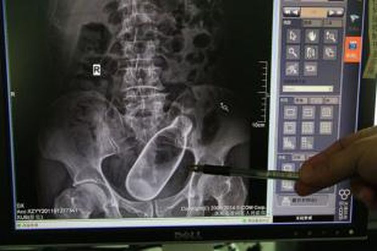 Foto rontgen ini dengan jelas memperlihatkan sebuah botol yang menyangkut di anus seorang pria di Zhuhai, China.