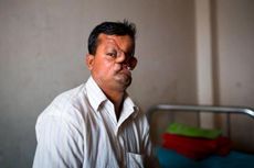 Pria Banglades Kehilangan Separuh Wajahnya akibat Dicabik Harimau 