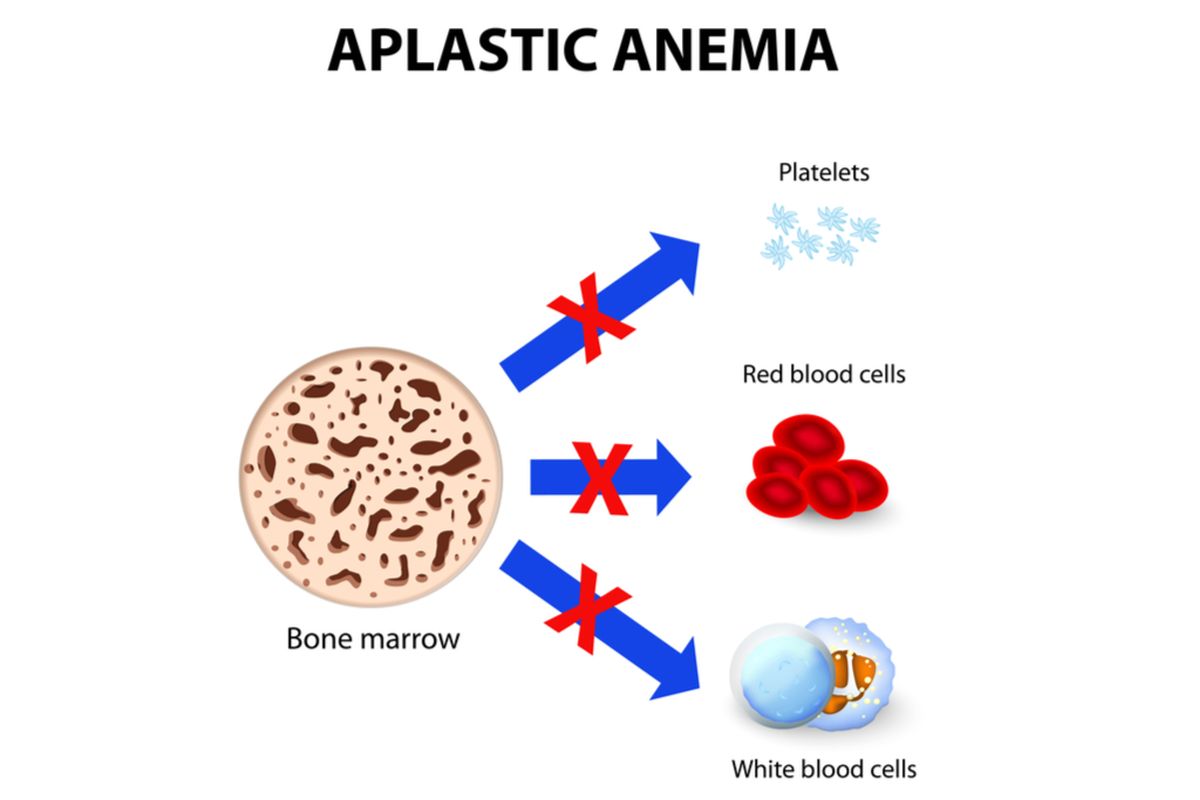 Ilustrasi anemia aplastik