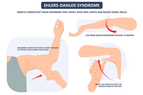 Sindrom Ehlers-Danlos
