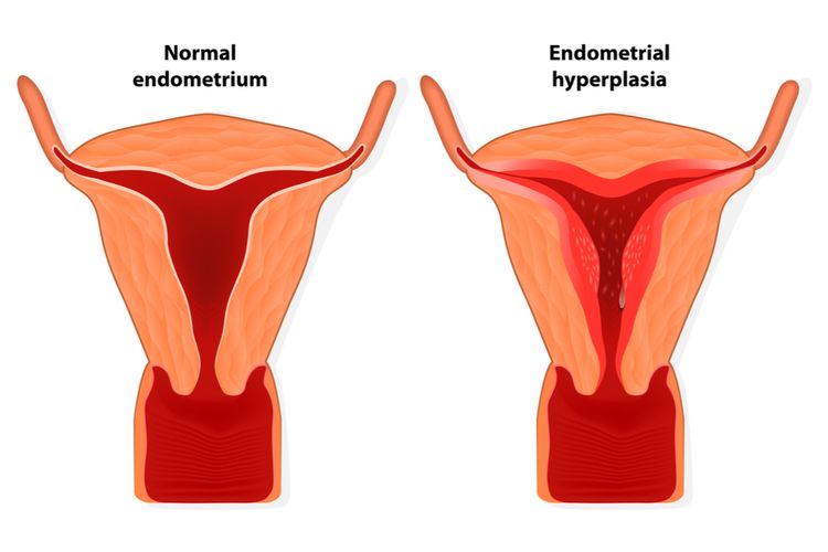 hiperplasia endometrium