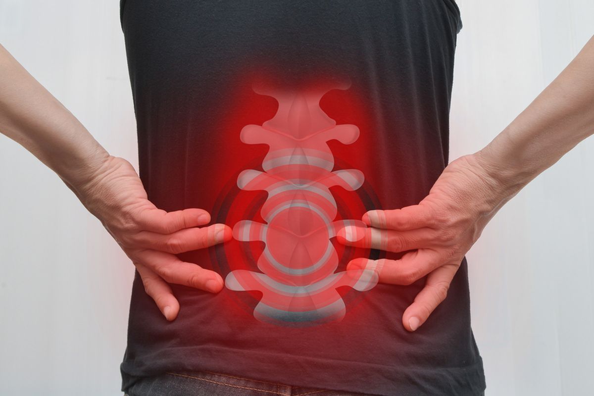 Ilustrasi sakit pinggang akibat nyeri tulang belakang, yang dapat menyebabkan saraf kejepit atau saraf terjepit.