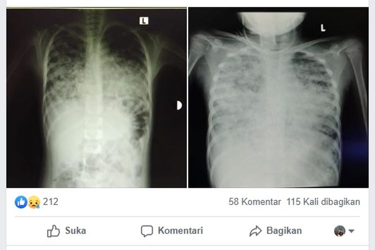 Tangkapan layar kondisi paru-paru milik seorang pasien anak berusia 7 tahun yang diduga positif terinfeksi virus corona. Perbandingan kedua foto paru kurang dari 24 jam infeksi semakin meluas telah terjadi pneumonia bilateral.