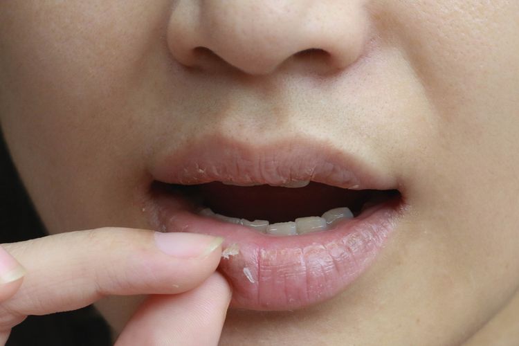 Salah satu penyebab bibir kering dan mengelupas adalah dehidrasi. 