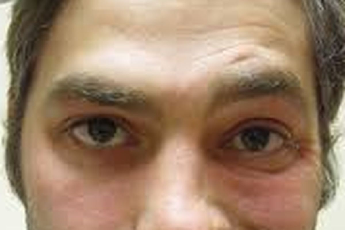 Contoh wajah tidak simetris pada bagian mata