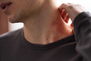 Herpes Penyakit Apa? Kenali Gejala dan Cara Mengobatinya
