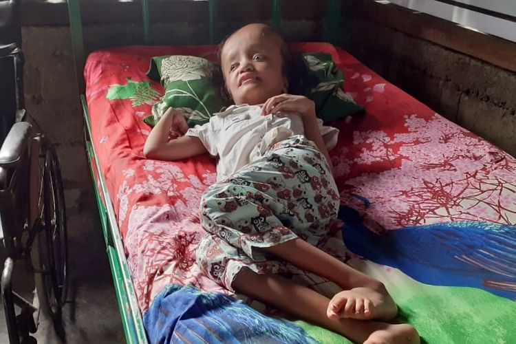 Foto : Mektildis Oktaviana (12), harus menahan sakit selama 11 tahun, 11 bulan terbaring ditempat tidur dengan kondisi kepala membesar, dirumahnya di Sokrutung, Desa Pantar,  Kecamatan Komodo,  Kabupaten Manggarai Barat, NTT.