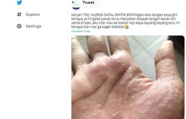 Ramai soal Bintik-bintik di Telapak Tangan yang Terasa Gatal dan ...
