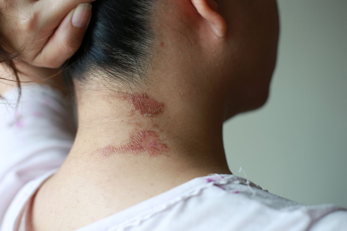 Ilustrasi gejala awal digigit tomcat, paparan racun tomcat bisa menyebabkan gejala ruam kemerahan dan kulit melepuh. 