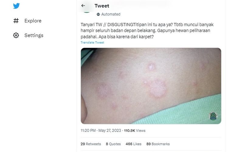 Ramai soal lesi merah di permukaan kulit mirip dengan ringworm, apa penyebabnya?